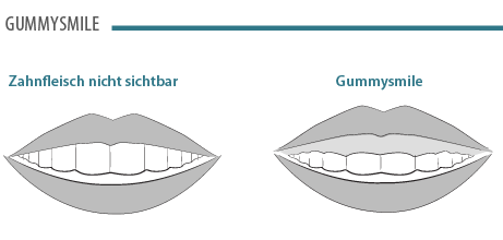 gummy-smile-korrektur.png 