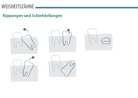 weisheitszaehne-fehlstellungen.png 